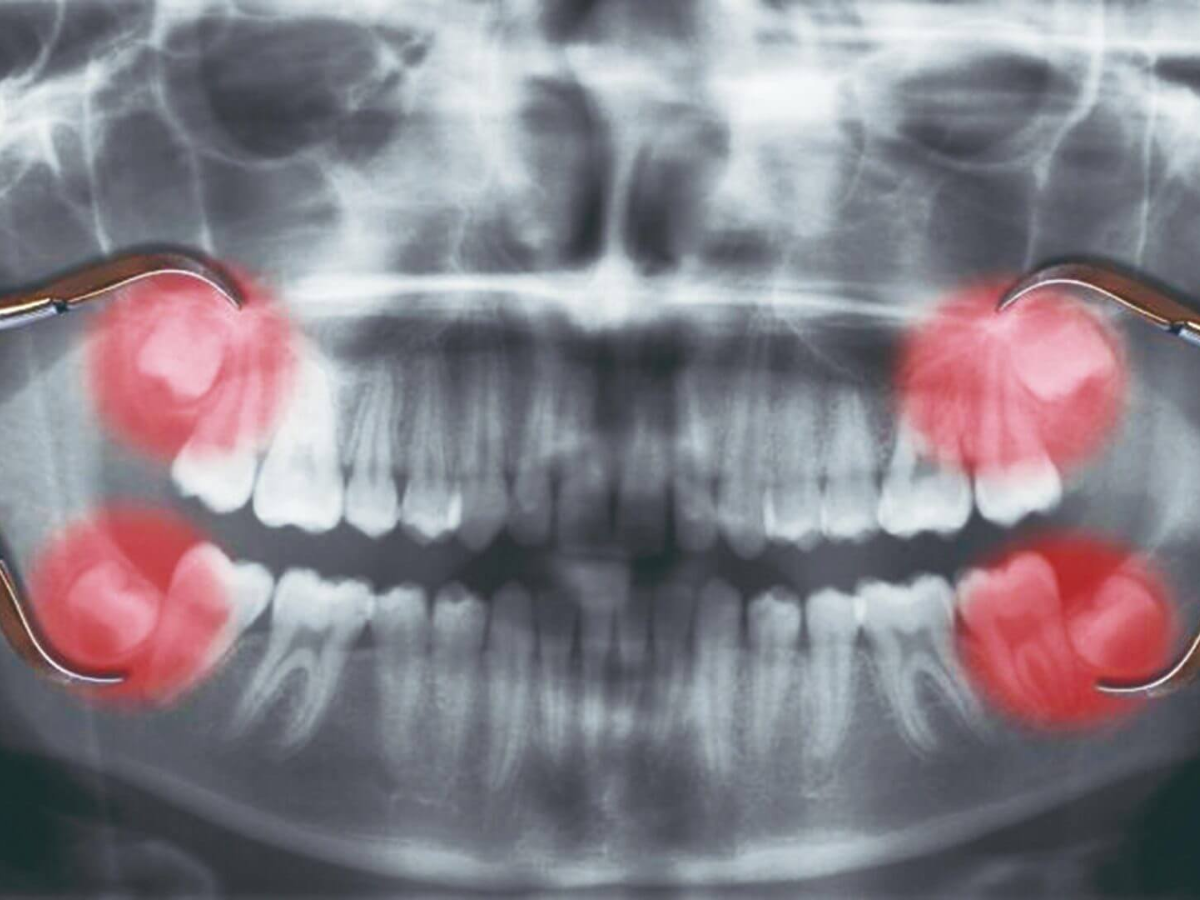 Quando Extrair o Siso? Riscos de Adiar a Cirurgia