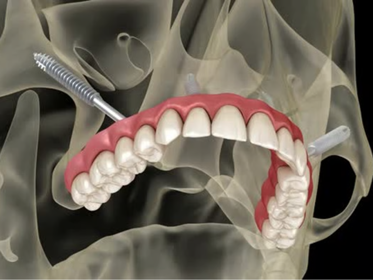 Implantes Zigomáticos: Quando são Indicados e Quais os Benefícios?